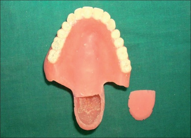The hollow bulb and a lid for the bulb were prepared separately. Both the bulb to the denture base and the lid to the bulb were attached using autopolymerizing acrylic resin