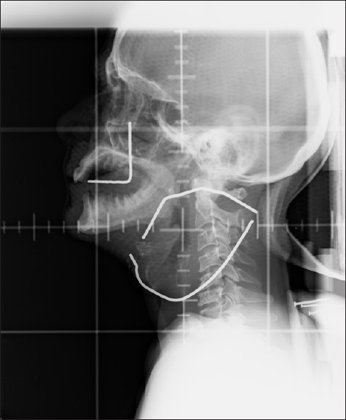 Simulator film of a patient: 69-year-old gentleman, a chronic smoker and a known case of Hansen's disease evaluated for neck swelling and hoarseness of voice for 6 months. ENT examination revealed a slough covered growth in the right pyriform sinus extending to the arytenoids, aryepiglottic fold up to the left arytenoids. Fine needle aspiration cytology from the node was reported as metastaic squamous cell carcinoma and was staged T2N3M0 (stage IVB disease inoperable stage) was planned for palliative radiotherapy. The node has been outlined with lead wire during simulation