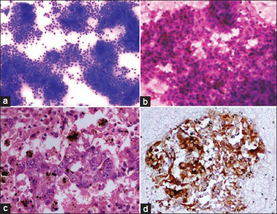 Fine-needle aspiration from the enhancing liver lesion. (a) Cellular smear with thickened trabeculae (Geimsa stain, ×100) (b) thickened trabeculae with vascular transgression, partial endothelial wrapping, bile stasis and malignant nuclear features of hepatocytes (H and E, ×200) (c) cell block preparation showing malignant hepatocytes with bile stasis (H and E, ×200) (d) cell block preparation with glypican 3 positivity (×200)