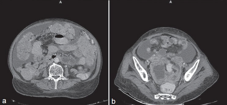 (a) Contrast-enhanced CT scan showsomental caking and ascites (b) Contrast-enhanced CT scan shows ascites and pelvic peritoneal thickening