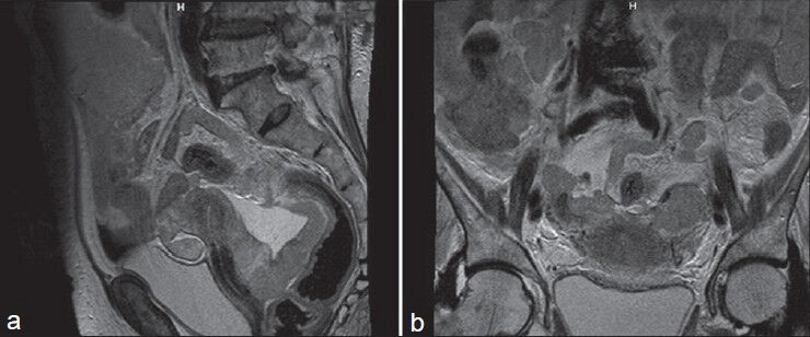 (a) T2 MRI showsuterus appear small and atrophic and thickened pelvic pritoneum. (b) T2 weighted MRI shows uterus and both adnexa appear unremarkable
