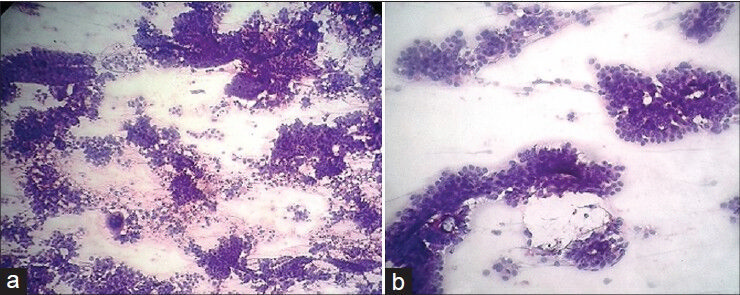 (a) Hematoxylin and eosin stain (H and E stain), (40) shows three-dimensional clusters, papillaroid arrangement, and multinucleated giant cells. (b) H and E stain (100) shows palisading of typical tumour cells