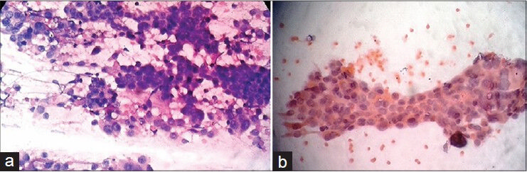 (a) H and E stain (×400) shows sheets and clusters of tumour cells having eccentric nuclei, prominent nucleoli. (b) Papanicolaou stain (400) shows papillary cluster of tumour cells