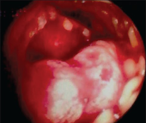 Endoscopic view of the ulceroproliferative lesion in the D2 segment of duodenum