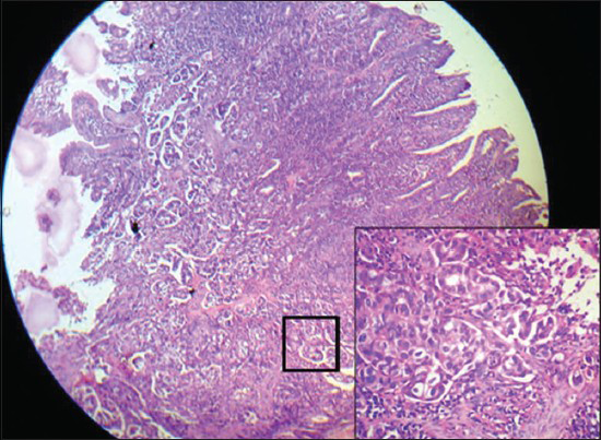 Duodenal biopsy: low power (×100) showing infiltrative malignant glands with overlying necrotic epithelium. (Inset box, ×400) Shows glandular structures lined by malignant cells