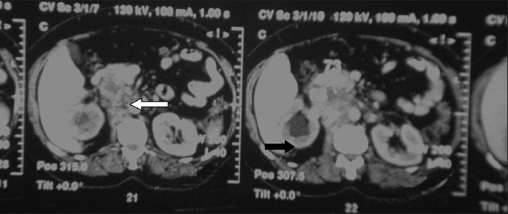 Computed tomography sections showing a heterogeneous retropritoneal mass (white arrow), of size 7.8 × 7 cm, with irregular calcification was seen centrally and right paramedian plane in the prevertebral region, encasing major vessels, right ureter and causing obstructive hydronephrosis on the right side (black arrow)