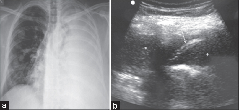 Hemorrhagic pleural effusion: Chest X-ray (a) of a woman with breast cancer shows opaque left hemithorax with mediastinal shift to right. Multiple nodular metastases are also seen in right lung. Ultrasound of chest (b) confirms presence of pleural effusion. In addition, there are fine internal debris (asterisk) and septation (arrow) within