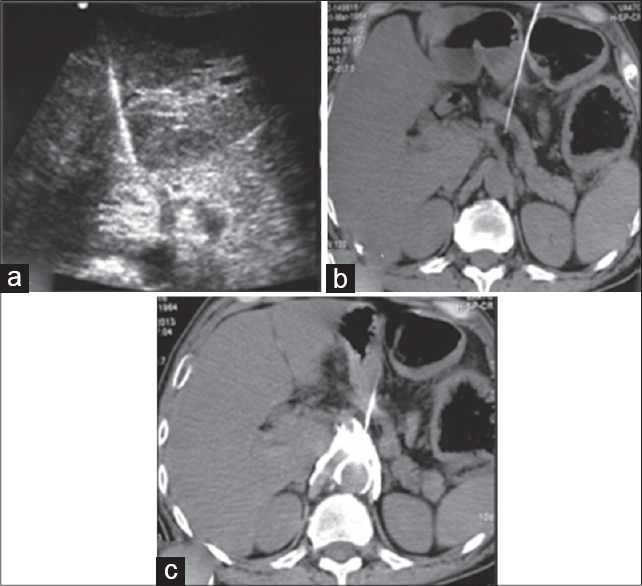 Ultrasound (USG)-guided celiac plexus neurolysis: USG demonstrates needle tip on the right side of celiac trunk (labeled in a) which was confirmed on subsequently performed unenhanced computed tomography (CT) scan (b). Drug spread was seen as echogenic cloud on USG (a) which was verified on CT (c)