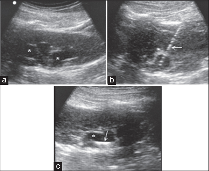 Bedside ultrasound-guided percutaneous nephrostomy to relieve urinary obstruction in a woman with Ca cervix: Baseline USG demonstrates hydronephrosis (asterisk in a and c). Needle (arrow in b) was inserted into the pelvicalyceal system, followed by serial tract dilatation. After completion of procedure, loop of pigtail catheter is visualized within the pelvicalyceal system