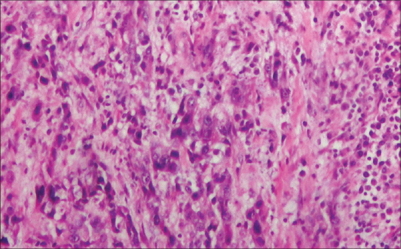 Microscopic histopathological appearance of anaplastic cells present diffusely as well as in the form of cords in a desmoplastic stromal background. The tumor cells show bizarre nuclei, irregular nuclear border, pleomorphic reticular to hyperchromatic irregular chromatin