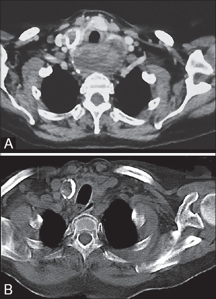 The presence of a large mass visibly causing obstruction of the esophagus (Panel A), which has completely regressed after four cycles of oral metronomic chemotherapy (Panel B)
