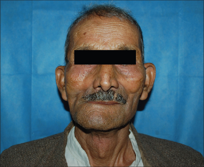 Six months postoperative photograph of the patient.