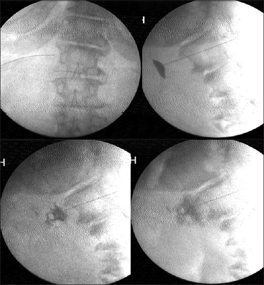 Transaortic approach to celiac plexus