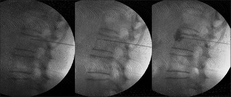 Splanchnic radiofrequency at T12