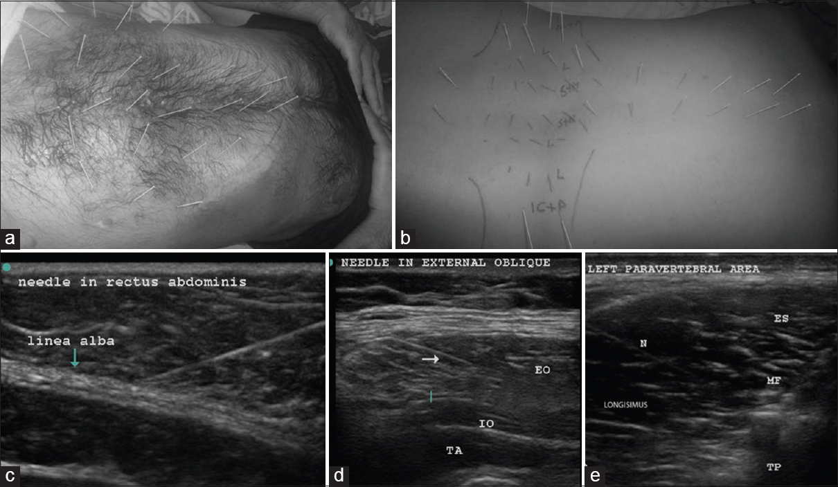 Upper row; abdominal muscle DN (a); in the abdominal wall about 7 pairs of needles were placed in rectus abdominis of each side equidistantly between the xiphisternum to the pubis. Three pairs were supraumbilical, 3 pairs were infraumbilical, and 1 pair was on either side of the umbilicus. About 3–4 needles were placed at a distance of 3–4 cm lateral to the needles in rectus abdominis, and another 3–4 needles were placed a further 3–4 cm lateral to the latter to target external and internal oblique muscles, as well as transversus abdominis between the costal margin and the inguinal ligament. The dark stains are betadine used as a medium for USG probe. The costal margin is marked with a blue line. Paravertebral muscle DN (b); the point of insertion was about 1 cm lateral to the spinous process on either side and medial to the facet for the spinalis and multifidi. An out of plane USG was used to visualize the needle tips clearly in the spinalis. The Figures b and e shows the length of the needle “in plane” in the longissimus. Longissimus and iliocostalis part of erector spinae were needled 4–6 cm lateral to the spine below the costal margin. The psoas at L3-5 on either side was visualized to place 3–4 needles in the muscle mass by starting far laterally so that the needle could slip beneath the transverse process (6–8 cm from the spinous process). The muscles targeted by the needles are marked on the figure as follows: S + M – Spinalis + Multifidus, L – longissimus, IC + P – Iliocostalis + Psoas. The costal margin and the iliac crests are also marked, the second row; USGDN: Needles (indicated by N or arrow) are visualized in rectus abdominis (c) EO: External oblique; (d) IO: Internal oblique, TA: Transversus abdominis, ES: Spinalis part of erector spinae, MF: Multifidus, TP: Transverse process; N: Needle in the longissimus (e)