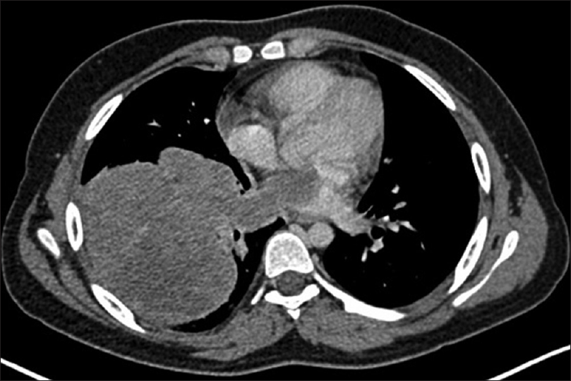 Computed tomography scan of thorax showing the mass in the right lower lobe with extension to the left atrium through the inferior pulmonary vein