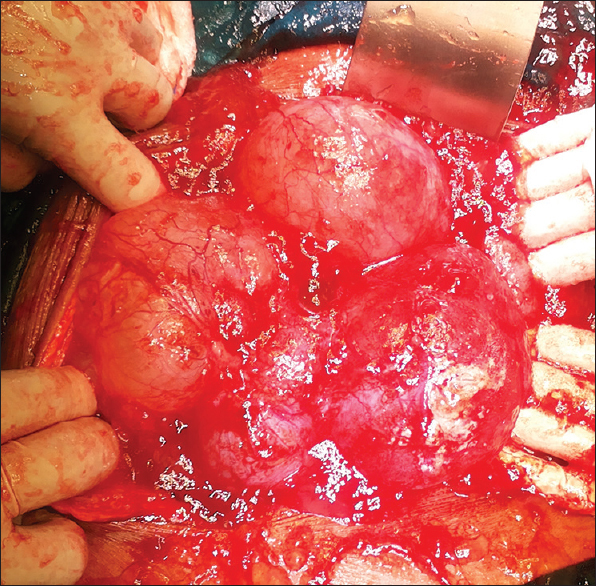 Bilateral multiloculated ovarian tumor