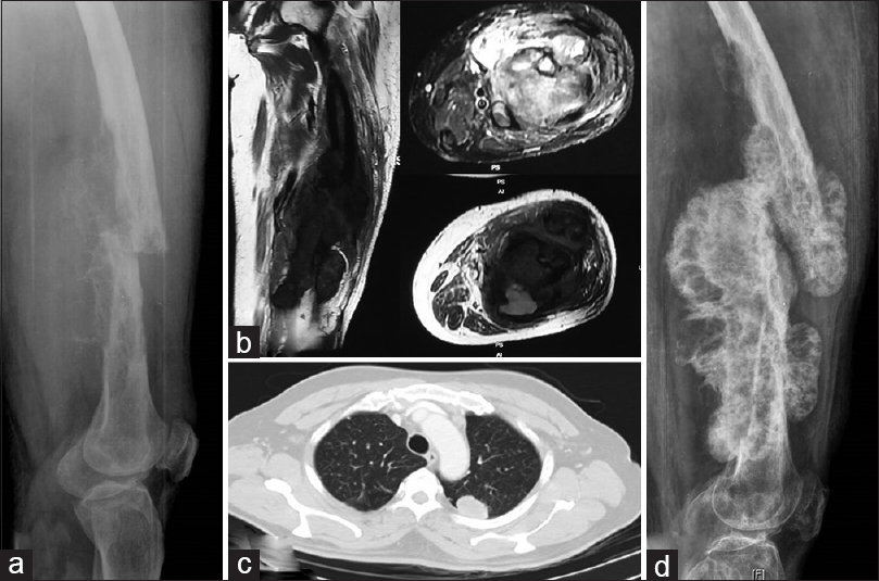 (a) Radiograph showing aggressive lytic lesion in diaphysis of the femur with pathological fracture (b) magnetic resonance image showing lesion involving entire length of the femur with soft-tissue component (c) computed tomographic image showing primary lung carcinoma (d) radiograph showing healed pathological fracture with good calcification of lesion, indicating good treatment response