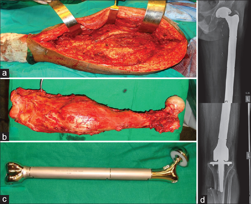 (a) Intraoperative picture showing defect following the total femur excision (b) total femur excised with good oncological margins (c) modular total femur prosthesis equal to the length of the patient's femur was reconstructed (d) radiograph showing total femur prosthesis at 9 months of follow-up