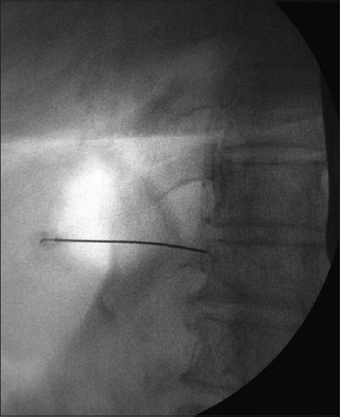 The anteroposterior view of the needle position in the splanchnic nerve block