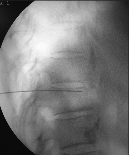 The lateral view of the needle position in the splanchnic nerve block