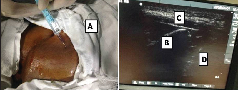 (A) Patient positioned for the block and local anesthetic being infiltrated in skin and subcutaneous tissue; Needle (B) seen in situ lying between the lateral pterygoid plate (C) and the maxilla (D)