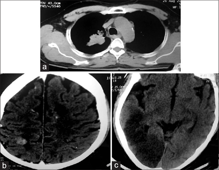 (a) Carcinoma of lung, (b) cerebral metastasis, (c) acute infarct in temporo-occipital region (venous origin)