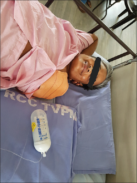 Smiling patient following removal of lymphedematous upper limb weighing 31 kg