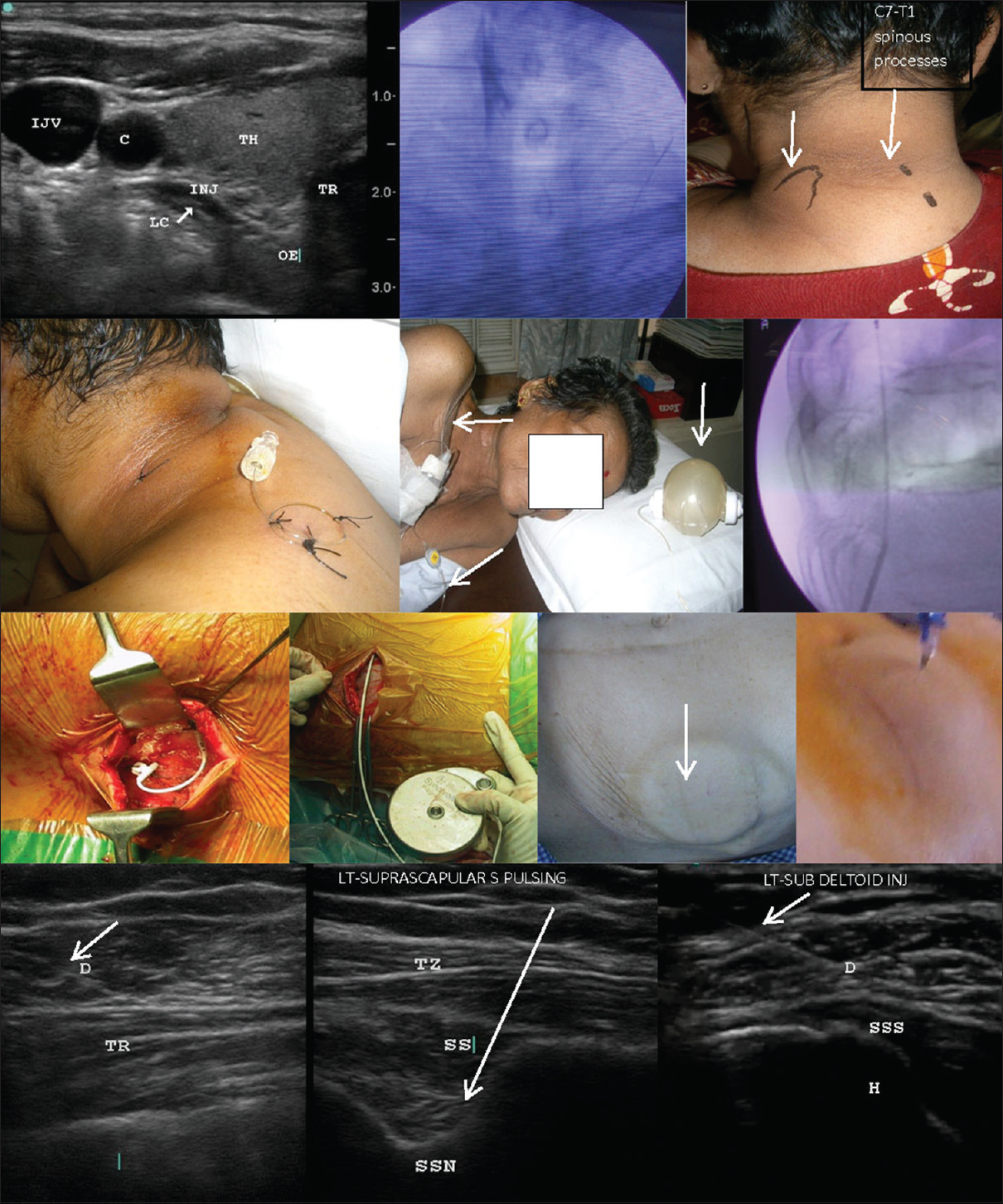 Neural interventions. First row, left: Ultrasound-guided stellate ganglion block showing the outline of the injectate anterior to the longus colli muscle; First row, center: Dye spread during fluoroscopy-guided stellate ganglion block at the sixth cervical vertebra, two levels above the first rib (arrow); First row, right: placement of the continuous brachial plexus block needle, introduced between the trapezius and levator scapulae (arrows) for posterior paravertebral brachial plexus block; Second row, left and center: the tunneled continuous brachial plexus block catheter is secured with stitches, looped over the shoulder, and connected to an elastomeric pump (center, arrows); Second row, right: fluoroscopic view of the intrathecal catheter emerging from the needle; Third row, left and center left: figures show the anchoring of the intrathecal catheter to the paravertebral fascia; Third row, center right and right: the silastic catheter is subcutaneously tunneled across the flank to be connected to the titanium pump subcutaneously implanted in the abdominal wall; the arrow indicates the refill port of the pump seen under the skin and the refill process; Fourth row: shoulder pulsed radiofrequency and injections under ultrasound guidance at the axillary nerve between the deltoid and trapezius (left), the suprascapular nerve in suprascapular notch (center), and the subdeltoid bursa between deltoid and supraspinatus tendon (right). The arrows indicate needles. C: Carotid artery, H: Humerus, IJV: Internal jugular vein, INJ: Injectate, LC: Longus colli, OE: Esophagus, D: Deltoid, TH: Thyroid, TR (first row): Trachea, TR (forth row): Triceps; TZ: Trapezius, SS: Supraspinatus, SSN: Suprascapular notch, SSS: Supraspinatus tendon.