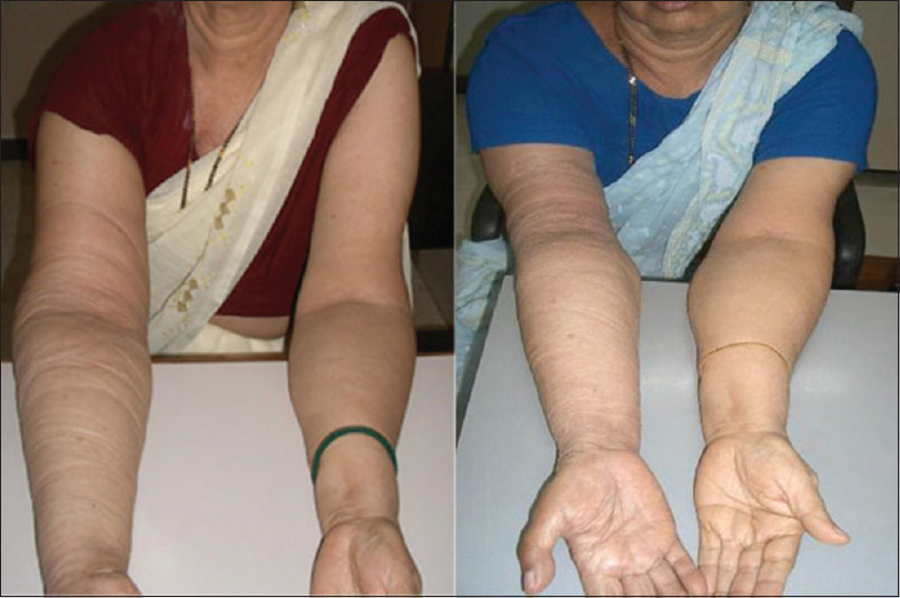 Effect of stellate ganglion block on lymphedema. Left: image was taken at baseline, showing swelling in the right arm. Right: image was taken 1-week poststellate ganglion block before the start of ultrasound-guided dry needling, showing reduction in swelling.