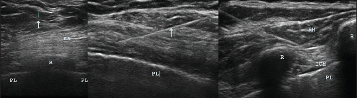 Ultrasound images showing needles in muscles. Ultrasound images were taken during USGDN, with arrows indicating needles in the serratus anterior overlying the rib and the pleura in the intercostal spaces (left); in the pectoralis major and minor overlying the pleura (center); and in the rhomboid and intercostal muscles (right). USGDN, ultrasound-guided dry needling.