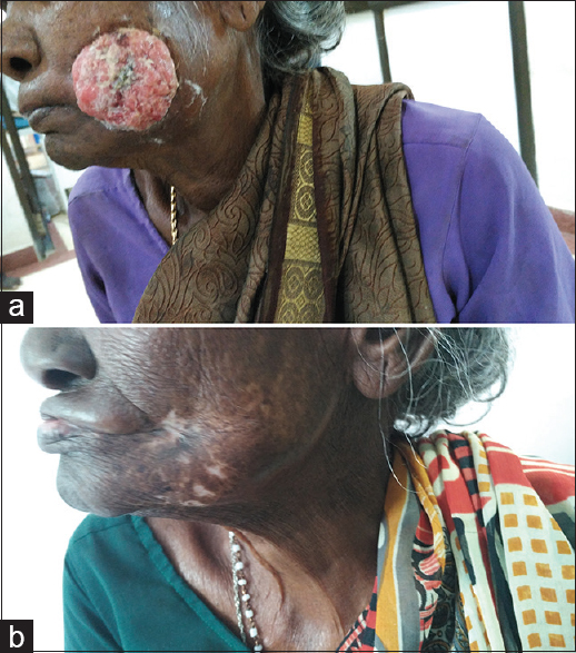 (a) A patient with Stage IVA Buccal mucosa cancer before receiving radiotherapy. (b) The same patient showing complete clinical response 2 months after radiotherapy completion