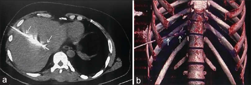 Radiofrequency ablation of metastatic lesion in liver from colorectal cancer: (a) Axial CT and volume rendered coronal reformatted image (b) showing the course of radiofrequency ablation probe and its expanded prongs in situ