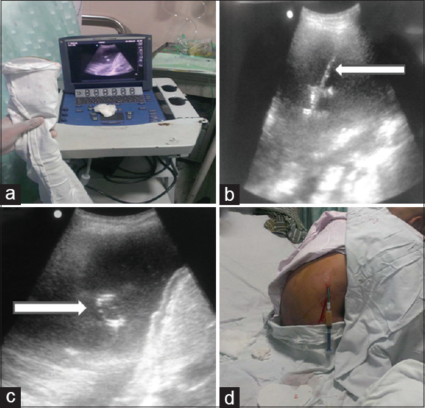Drainage of pleural effusion: (a) Ultrasound screen and convex probe wrapped and duly covered using aseptic precautions. (b) Ultrasonography image showing echogenic needle within the pleural fluid (arrow). Subsequently deployed pigtail catheter is seen in situ as it forms loop (arrow in c). The patient sits comfortably after pigtail insertion till the catheter is sutured to skin (d)