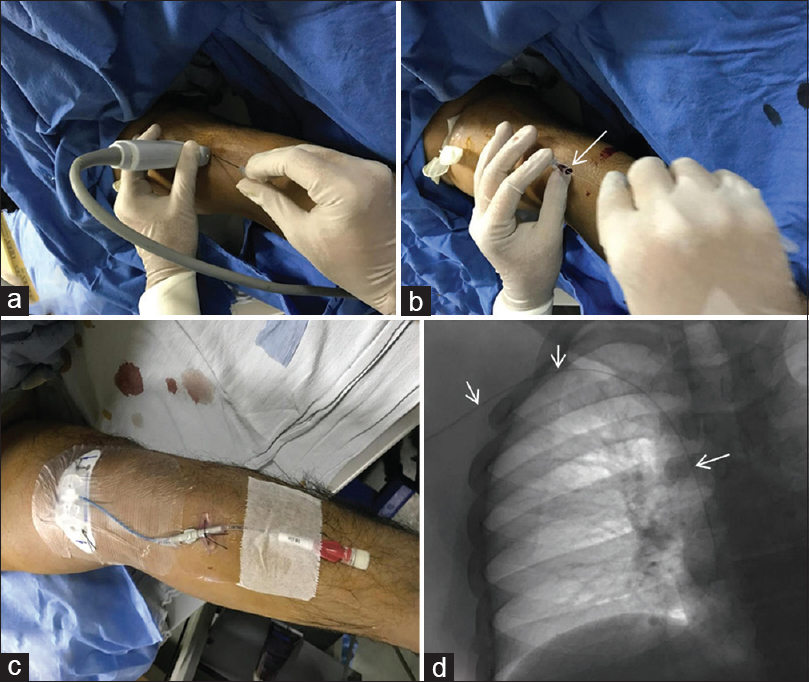 Peripherally inserted central venous catheter: (a) Venous puncture under ultrasonography guidance is performed followed by establishing access using guidewire (arrow in b). (c) Central venous catheter is placed over the guidewire and position confirmed on radiograph or fluoroscopy spot image (arrows, d)