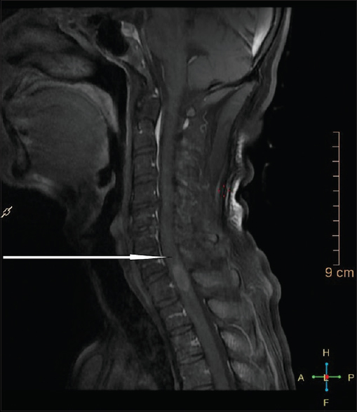 D1 intramedullary lesion (pointed with arrow)