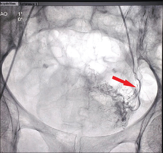 Superselective left superior vesical artery angiogram showing engorgement