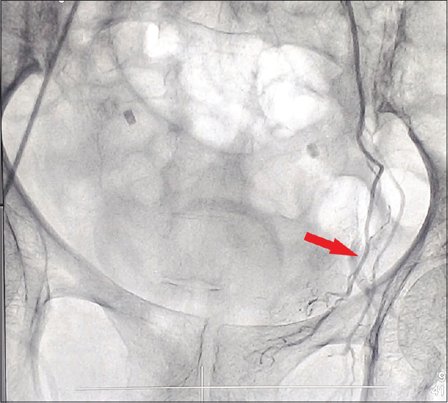 Superselective left inferior vesical artery angiogram