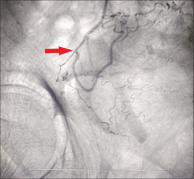 Superselective right superior vesical artery angiogram