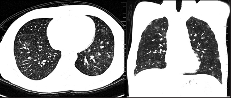 HRCT chest with bleomycin pulmonary toxicity showing multiple nodular ground glass areas diffusely involving both the lungs representing mild and early changes of lung injury