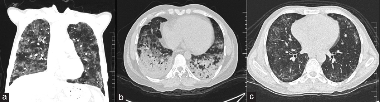 HRCT showing classical appearance of lung toxicity as extensive diffuse alveolar damage in bilateral lungs seen as a) Diffuse ground glass opacities and b) Ground glass opacity and areas of basal consolidation c) NSIP pattern