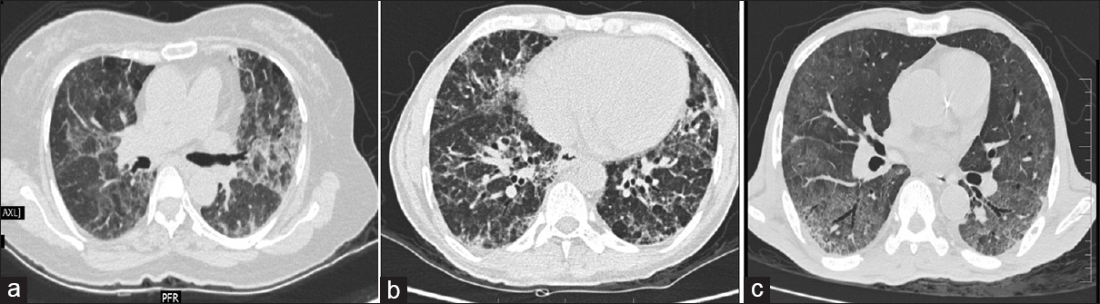 HRCT changes representing sequel of bleomycin toxicity, a) Fibrotic type of NSIP b) DAD with bronchiectasis and septal thickening c) UIP pattern