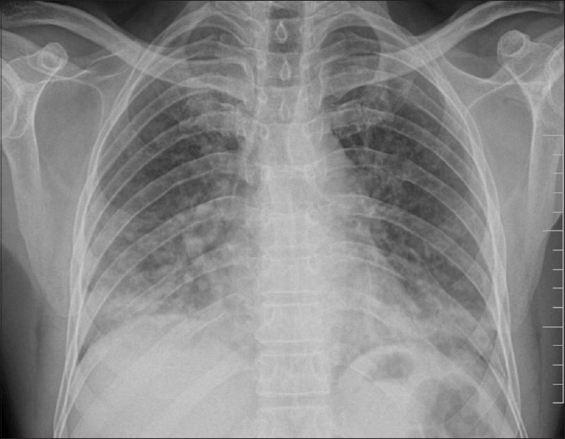 Chest X-ray showing nodular and patchy opacities predominantly in lower zones