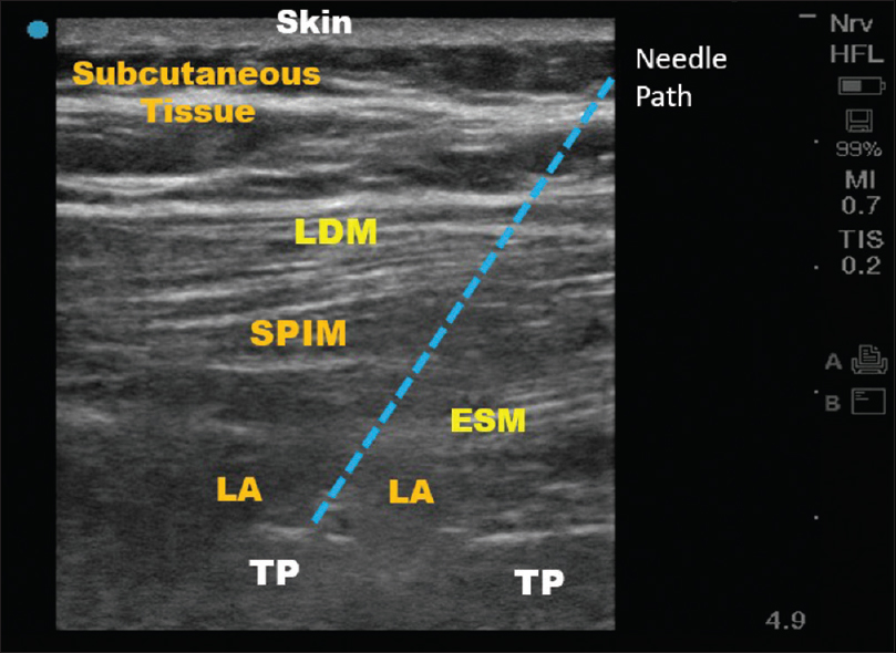 The sonographic image of lumbar erector spinae plane block. LDM: Latissmus dorsi; SPIM: Serratus posterior inferior muscle; ESM: Erector spinae muscle; LA: Local anesthetic, TP: Transverse process