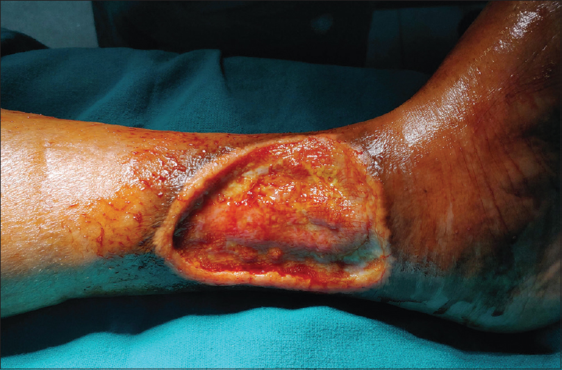 Note a wide healing ulcer on medial aspect of the left foot due to the prolonged use of an intravenous cannula