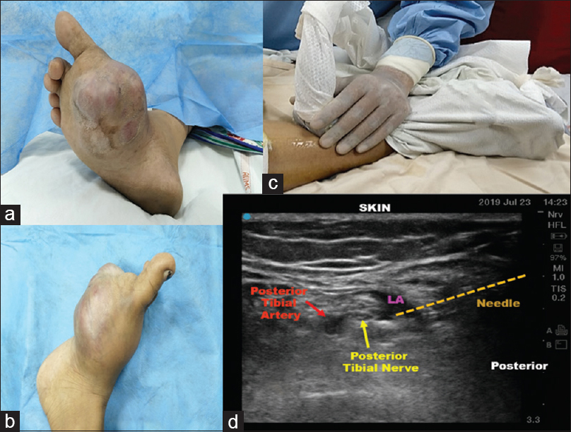 (a and b) Schwannoma of right foot, (c) probe position, (d) posterior tibial nerve block. LA = Local anesthetic.