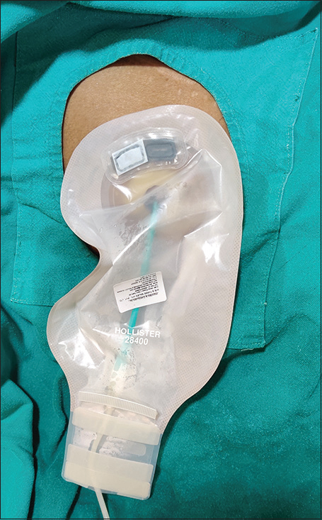 Image showing colostomy bag applied around the site of insertion of pigtail catheter