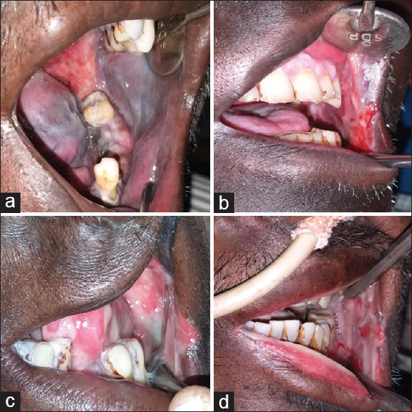 Different grades of oral mucositis (Radiotherapy Oncology Group scoring criteria), (a) Grade 1 mucositis showing mild changes in the lining mucosa, (b) Grade 2 patchy mucositis that produces inflammatory serosanguinous discharge in the buccal mucosa, (c) Grade 3 confluent mucositis involving buccal mucosa, lip, and tongue, (d) Grade 4 mucositis showing ulceration and hemorrhage alimentation not possible