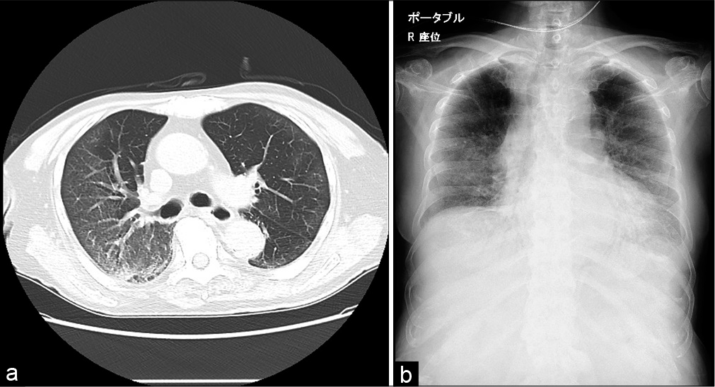 (a) Lung CT on day 1. (b) Chest X-ray on day 8.