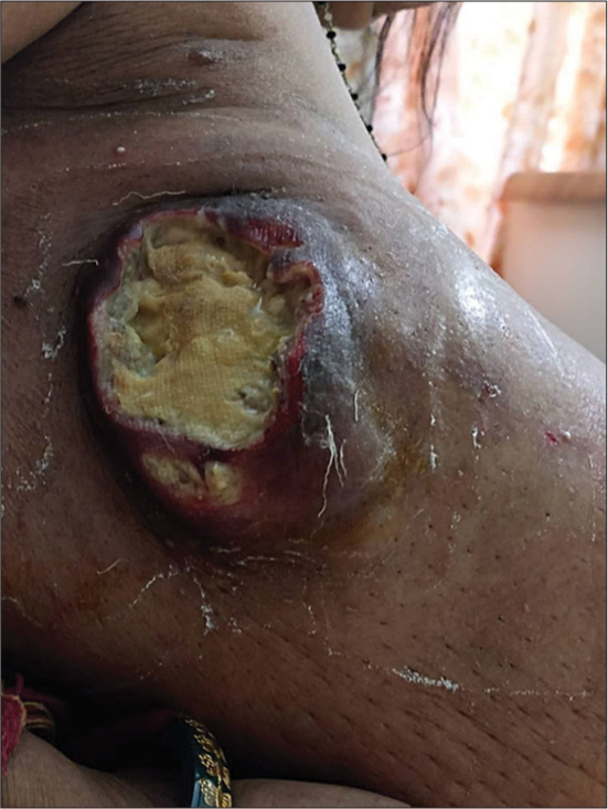 Wound after 10 days of bandaging. Absence of lymphorrhoea with the reduction in periwound induration and resolution of satellite wounds.